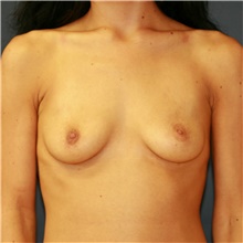 Breast Augmentation Before Photo by Steve Laverson, MD, FACS; Rancho Santa Fe, CA - Case 41051