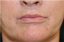 Lip Augmentation/Enhancement After Photo by Steve Laverson, MD, FACS; Rancho Santa Fe, CA - Case 41054