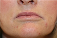 Lip Augmentation/Enhancement Before Photo by Steve Laverson, MD, FACS; Rancho Santa Fe, CA - Case 41054