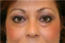 Eyelid Surgery Before Photo by Steve Laverson, MD; San Diego, CA - Case 41055