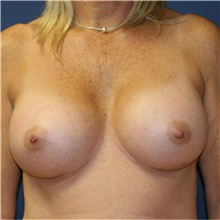 Breast Augmentation After Photo by Steve Laverson, MD, FACS; Rancho Santa Fe, CA - Case 41069