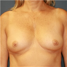 Breast Augmentation Before Photo by Steve Laverson, MD, FACS; Rancho Santa Fe, CA - Case 41069