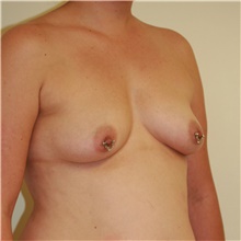 Breast Augmentation Before Photo by Steve Laverson, MD, FACS; Rancho Santa Fe, CA - Case 41080