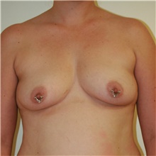 Breast Augmentation Before Photo by Steve Laverson, MD, FACS; Rancho Santa Fe, CA - Case 41080