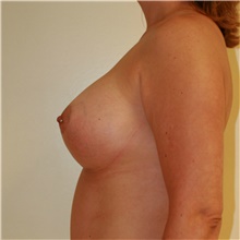 Breast Augmentation After Photo by Steve Laverson, MD, FACS; Rancho Santa Fe, CA - Case 41080