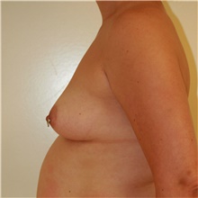 Breast Augmentation Before Photo by Steve Laverson, MD, FACS; Rancho Santa Fe, CA - Case 41080