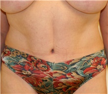 Tummy Tuck After Photo by Steve Laverson, MD, FACS; Rancho Santa Fe, CA - Case 41081