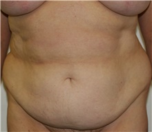 Tummy Tuck Before Photo by Steve Laverson, MD, FACS; Rancho Santa Fe, CA - Case 41081