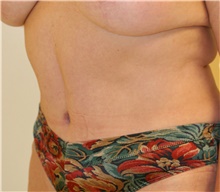 Tummy Tuck After Photo by Steve Laverson, MD, FACS; Rancho Santa Fe, CA - Case 41081