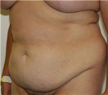 Tummy Tuck Before Photo by Steve Laverson, MD, FACS; Rancho Santa Fe, CA - Case 41081