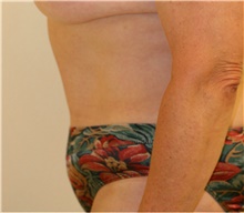 Tummy Tuck After Photo by Steve Laverson, MD, FACS; Rancho Santa Fe, CA - Case 41081