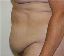 Tummy Tuck Before Photo by Steve Laverson, MD, FACS; Rancho Santa Fe, CA - Case 41081