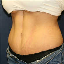 Tummy Tuck After Photo by Steve Laverson, MD; San Diego, CA - Case 41096