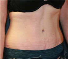 Tummy Tuck After Photo by Steve Laverson, MD, FACS; Rancho Santa Fe, CA - Case 41108