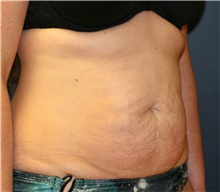 Tummy Tuck Before Photo by Steve Laverson, MD, FACS; Rancho Santa Fe, CA - Case 41108