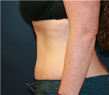 Tummy Tuck After Photo by Steve Laverson, MD, FACS; Rancho Santa Fe, CA - Case 41108