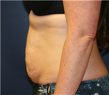 Tummy Tuck Before Photo by Steve Laverson, MD, FACS; Rancho Santa Fe, CA - Case 41108