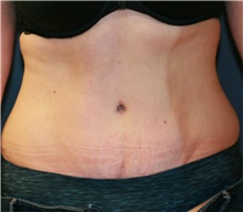 Tummy Tuck After Photo by Steve Laverson, MD, FACS; Rancho Santa Fe, CA - Case 41108