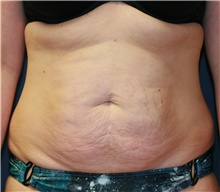 Tummy Tuck Before Photo by Steve Laverson, MD, FACS; Rancho Santa Fe, CA - Case 41108