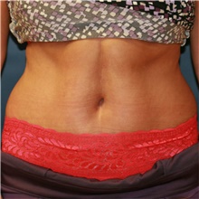 Tummy Tuck After Photo by Steve Laverson, MD, FACS; Rancho Santa Fe, CA - Case 41122