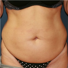 Tummy Tuck Before Photo by Steve Laverson, MD, FACS; Rancho Santa Fe, CA - Case 41122