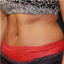 Tummy Tuck After Photo by Steve Laverson, MD, FACS; Rancho Santa Fe, CA - Case 41122