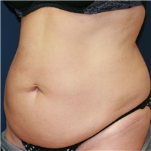 Tummy Tuck Before Photo by Steve Laverson, MD, FACS; Rancho Santa Fe, CA - Case 41122