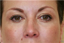 Eyelid Surgery After Photo by Steve Laverson, MD, FACS; Rancho Santa Fe, CA - Case 41123