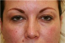 Eyelid Surgery Before Photo by Steve Laverson, MD, FACS; San Diego, CA - Case 41123