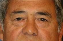 Eyelid Surgery Before Photo by Steve Laverson, MD, FACS; San Diego, CA - Case 41138