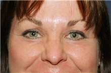 Eyelid Surgery After Photo by Steve Laverson, MD, FACS; Rancho Santa Fe, CA - Case 41139