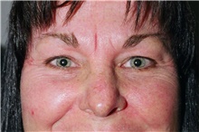 Eyelid Surgery Before Photo by Steve Laverson, MD, FACS; Rancho Santa Fe, CA - Case 41139