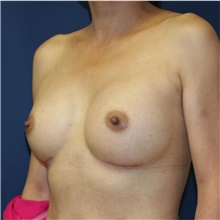 Breast Augmentation After Photo by Steve Laverson, MD, FACS; Rancho Santa Fe, CA - Case 41197