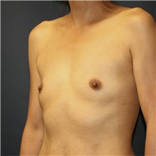 Breast Augmentation Before Photo by Steve Laverson, MD, FACS; San Diego, CA - Case 41197