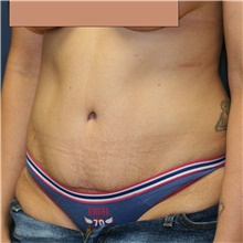Tummy Tuck After Photo by Steve Laverson, MD; San Diego, CA - Case 41209
