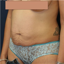 Tummy Tuck Before Photo by Steve Laverson, MD; San Diego, CA - Case 41209
