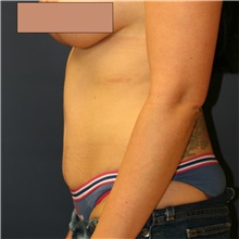 Tummy Tuck After Photo by Steve Laverson, MD; San Diego, CA - Case 41209
