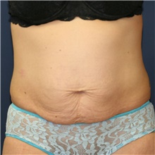 Tummy Tuck Before Photo by Steve Laverson, MD; San Diego, CA - Case 41209
