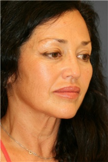 Facelift Before Photo by Steve Laverson, MD, FACS; Rancho Santa Fe, CA - Case 41225