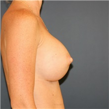 Breast Augmentation After Photo by Steve Laverson, MD, FACS; Rancho Santa Fe, CA - Case 41228