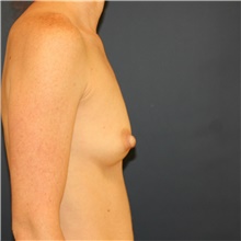 Breast Augmentation Before Photo by Steve Laverson, MD, FACS; Rancho Santa Fe, CA - Case 41228