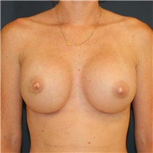 Breast Augmentation After Photo by Steve Laverson, MD, FACS; Rancho Santa Fe, CA - Case 41228