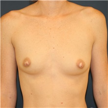 Breast Augmentation Before Photo by Steve Laverson, MD, FACS; Rancho Santa Fe, CA - Case 41228