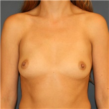 Breast Augmentation Before Photo by Steve Laverson, MD, FACS; Rancho Santa Fe, CA - Case 41232