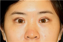 Eyelid Surgery After Photo by Steve Laverson, MD, FACS; Rancho Santa Fe, CA - Case 41233