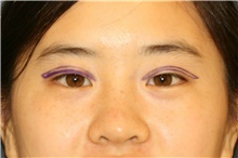Eyelid Surgery Before Photo by Steve Laverson, MD, FACS; Rancho Santa Fe, CA - Case 41233