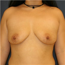 Breast Augmentation Before Photo by Steve Laverson, MD; San Diego, CA - Case 41239