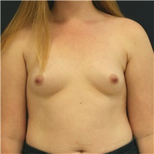 Breast Augmentation Before Photo by Steve Laverson, MD, FACS; Rancho Santa Fe, CA - Case 41269