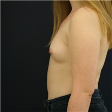 Breast Augmentation Before Photo by Steve Laverson, MD, FACS; Rancho Santa Fe, CA - Case 41269