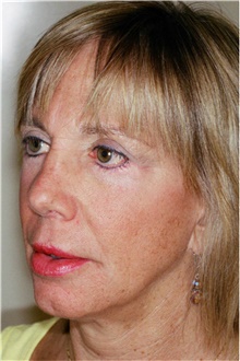 Rhinoplasty After Photo by Steve Laverson, MD, FACS; Rancho Santa Fe, CA - Case 41293